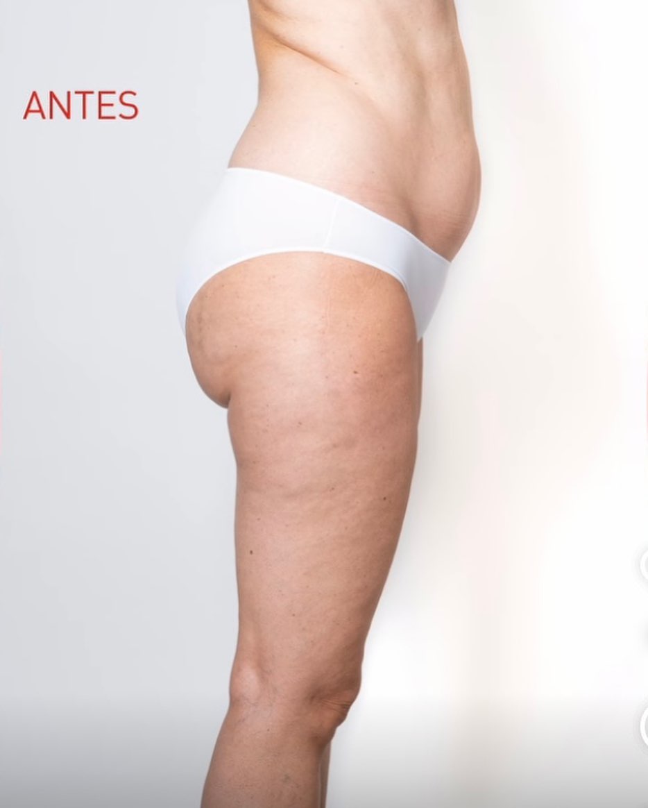 Estat abans del tractament corporal