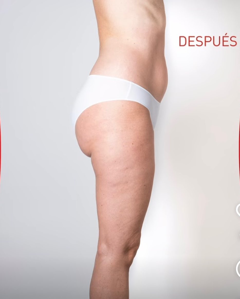 Resultat després del tractament corporal